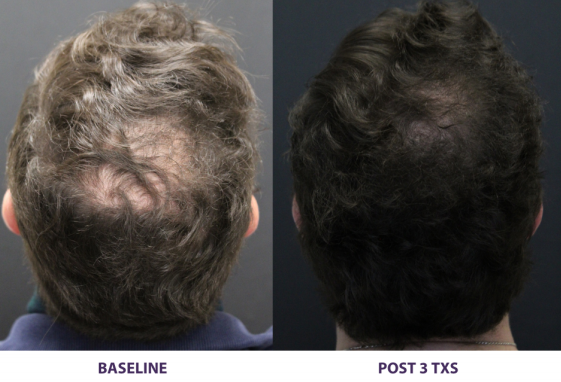 Alma TED — hairline and coverage